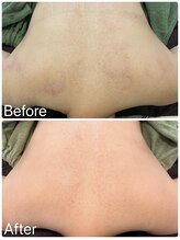 サロンドフェイス(Salon de Faith)/背中ハーブピーリング5回