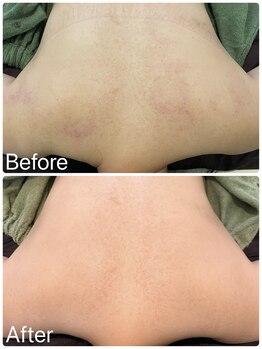 サロンドフェイス(Salon de Faith)/背中ハーブピーリング5回