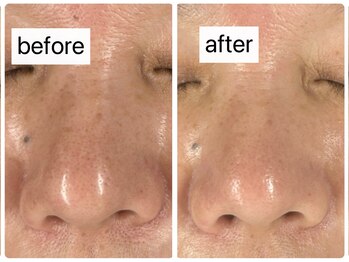 マハロ(Mahalo.N)/オーダーフェイシャル【毛穴】