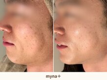 マイナプラ 表参道(myna+)/肌質改善/小顔