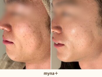 マイナプラ 表参道(myna+)/肌質改善/小顔