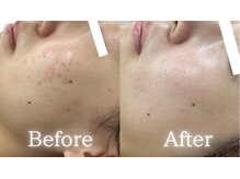 ラ ルアナ(La Luana)の雰囲気（ハイドロ毛穴洗浄・ララピールでニキビ/シミのない素肌へ♪）