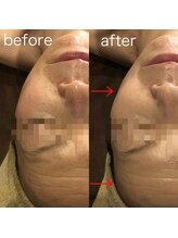 ディースズ(D.suzu)/白玉リフティングbefore/after