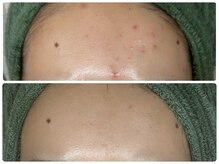 ベル(Bell)/ハーブピーリング６回の施術