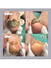 巻き爪補正店 天王寺店/長年かけて分厚くなったお爪