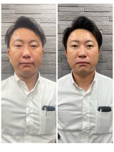 長寿鍼灸院 長寿整骨院/men's美容鍼・超絶コース★