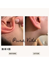 プーラビーダ 川西能勢口店(PuraVida)/耳脱毛