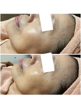 リッツ 草加店(Ritz)/【Before/After】しわ改善