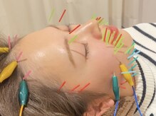 恵比寿すこやか鍼灸整骨院/リフトアップ特化型美容鍼