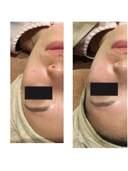 世田谷ビューティークリニーク 池尻大橋/ハーブピーリングの効果★