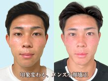 ナチュラルビューティーフェイス 横浜(NBF)/メンズ小顔矯正/横浜/頬骨の歪み