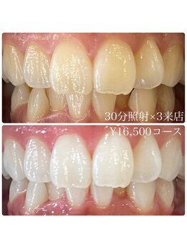 ホワイトニングルーム 川崎店(WhiteningRoom)/ホワイトニング/川崎