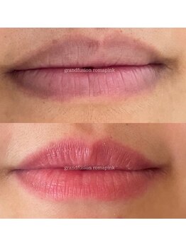 アティロン(Attirant)/【黒ずみ/くすみ改善】