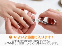 レアム/深爪には丁寧なケアが必須。