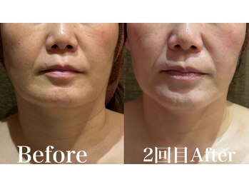 ディアーム 光明池店(Diarm)/韓国式脂肪分解レッドショット