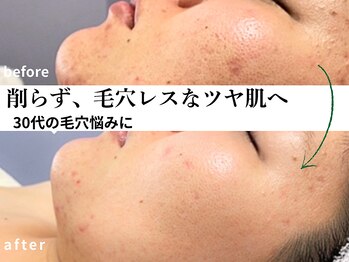 ソレイユ(Soleil)の写真/30代の開いた毛穴に|次世代ピーリングで肌を削らず、毛穴の目立たないハリとツヤのある陶器肌へ