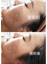 マーレ(Ma～re)/20代お肌のお悩み