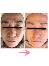 コーラル(Coral)/LDM水玉リフティング施術結果