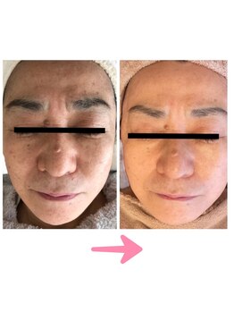 コーラル(Coral)/LDM水玉リフティング施術結果