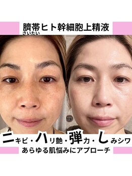 チュベルフェ(tu belle fe)/ヒト臍帯幹細胞◆水光ジェット◆