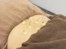 スタイル鍼灸整骨院の雰囲気（大人気鍼灸メニュー！）