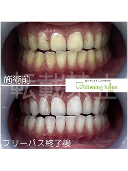 ホワイトニングサロン 札幌店/【ホワイトニング】#札幌#大通り