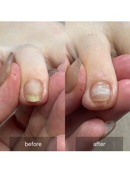 アイル(isle)/【人差し指の巻き爪】でお悩み