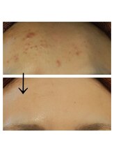 エステサロン カラーズ(COLORS)/ニキビ毛穴の肌質改善も♪