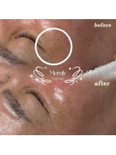 メルリー(Meruly)/目元のシワも1度でこの変化！