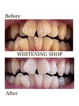 ホワイトニングショップ 津店/Before After/10回