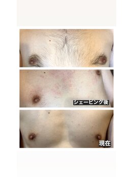 スパフランコルシャン(Spa Francorchamps)/メンズ脱毛【胸毛】