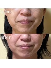 薫風/サーマトリックス／40代