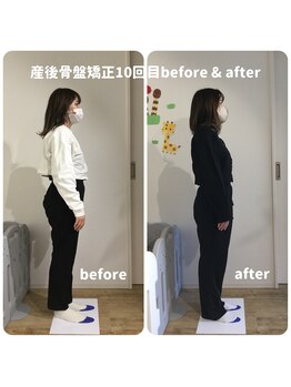 シンプル(Simple.)/産後骨盤矯正10回目の変化
