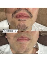 ユウユウ(YUYU)/ヒゲ脱毛　LED×WAX