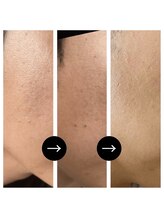 スキンラボ 新宿(@SkinLabo)/フォトRF　細かいシミ改善と凹凸