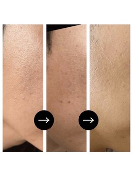 スキンラボ 新宿(@SkinLabo)/フォトRF 細かいシミ改善と凹凸