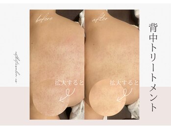 エステティックサロン シーズ/背中トリートメント