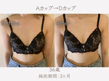 ハリスタ 西宮院(HARISTA)/3ヶ月間でAカップ→Dカップ