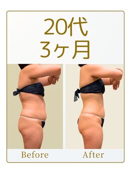 キュール(KuhL)/20代痩身ビフォーアフター☆
