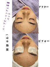 エステティック シャララ(Sha la la)/ビフォーアフターのお写真