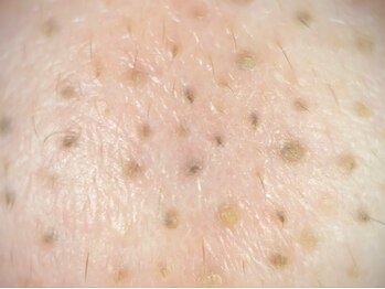 メナードフェイシャルサロン 浜北駅前/小鼻の汚れ!!