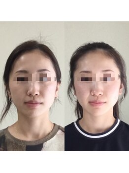 トータルトリートメント優鍼灸院/美容鍼2回の効果