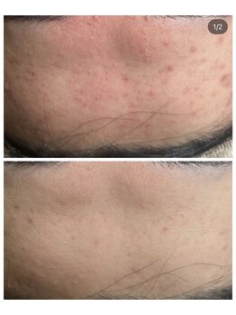 エミルカ 自由が丘店(EMILUCA)/おでこのニキビ、赤みに