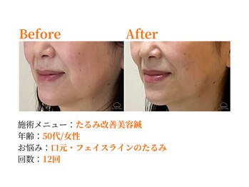 シルエラバレ(CiruelaValle)/Before After