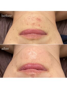 シャンティ(Shanti)/浜松市中区結果だし痩身専門店