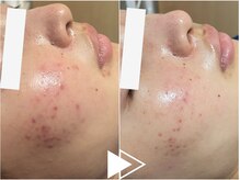 リシェス(Richesse)/ニキビケア★初回¥9990