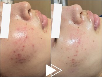 リシェス(Richesse)/ニキビケア★初回¥9990