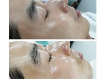 アネモネ ビューティーズ サロン(Anemone Beauty's salon)/ララピールBefore→After