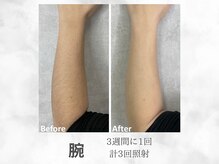 ベル(Belle)/メンズ腕脱毛