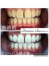 ホワイトニングサロン 京都烏丸店/ホワイトニング施術例